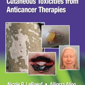 Cutaneous Toxicities from Anticancer Therapies
